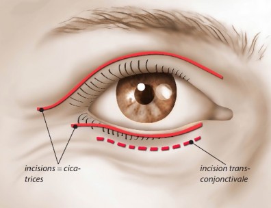 Blepharoplastie