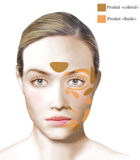 Injection d’acide hyaluronique