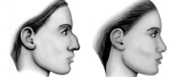 Rhinoplastie
