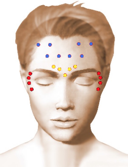 Injection de toxine botulique (botox)