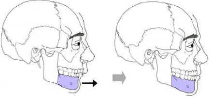 Ostéotomie de la mandibule